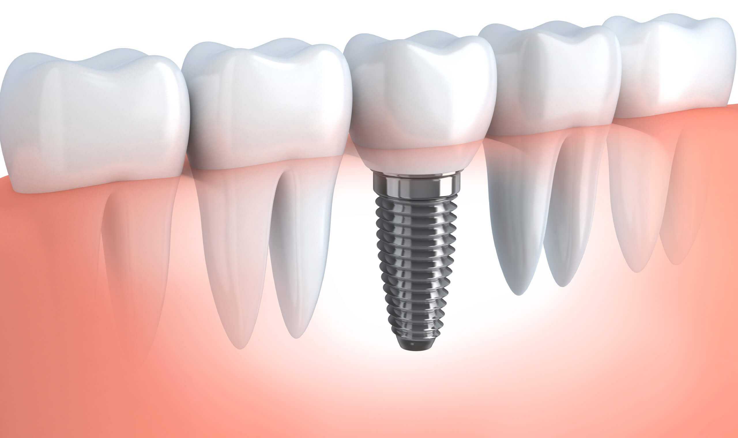 Dental Implant Edmonton